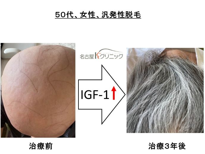 円形脱毛症　病院